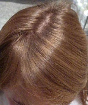 hair loss in teenagers